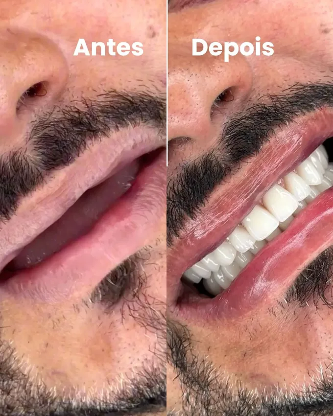 Antes e depois de reabilitação estética do sorriso em Cuiabá