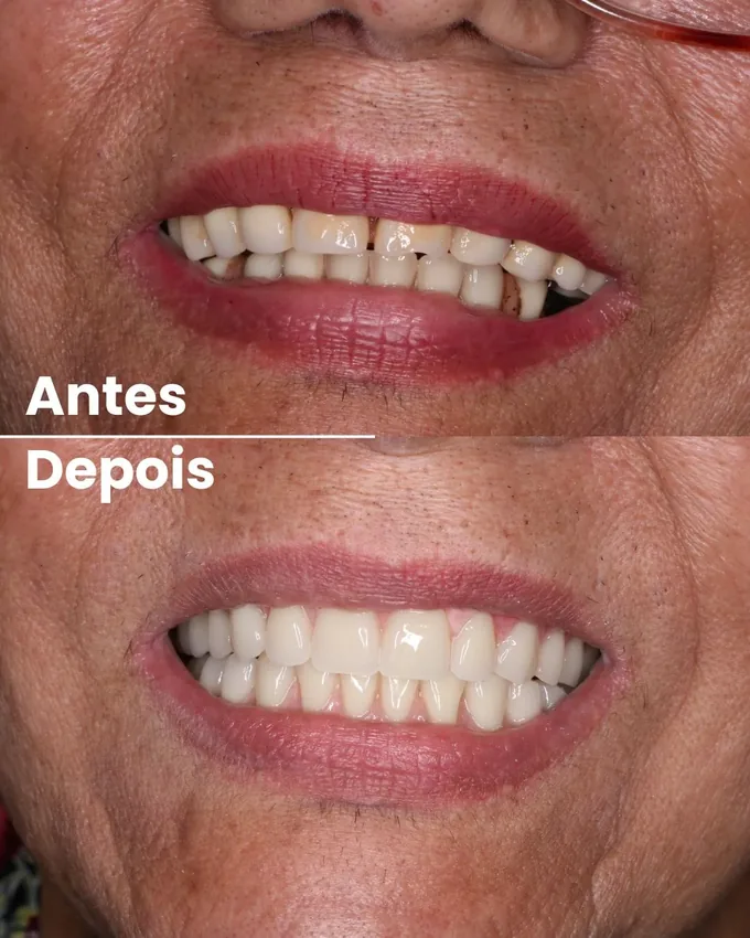 Antes e depois de implante dentário em Cuiabá, caso 5, na clínica da Dra. Amanda Marangon