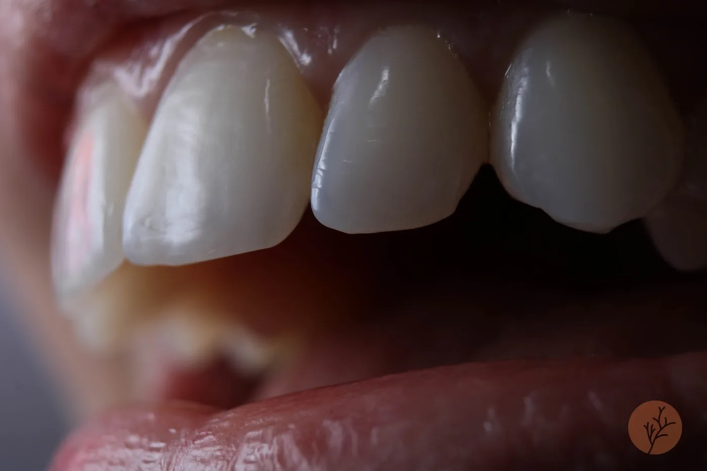 Close do resultado de uma prótese dentária realizada pela Dra. Amanda Marangon